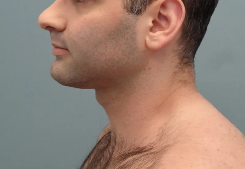 Chin Implant Before & After Pictures in Nashville, TN