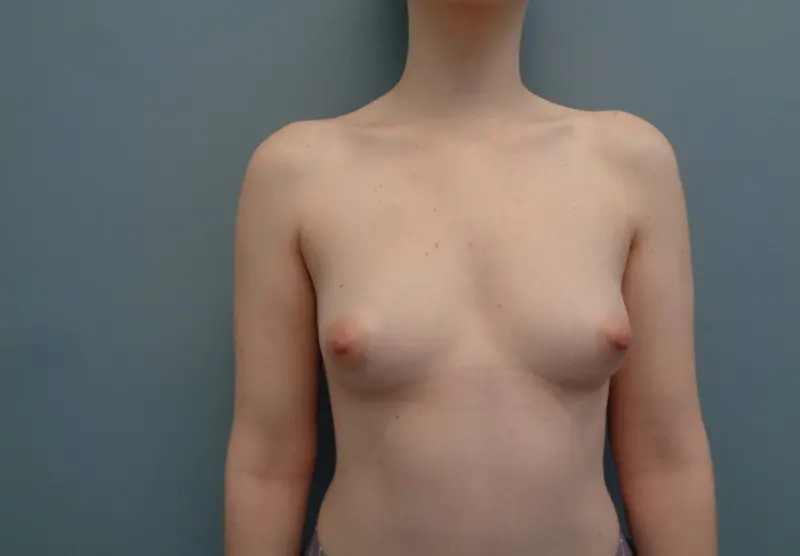 Breast Augmentation Before & After Pictures in Nashville, TN