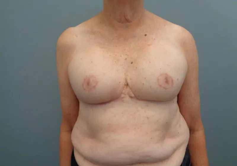 Implant Based reconstruction Before & After Pictures in Nashville, TN