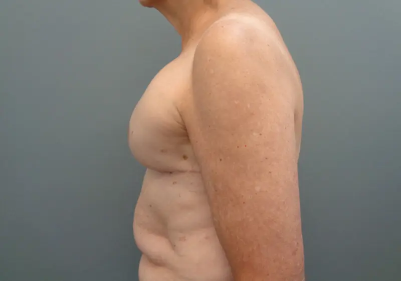 Implant Based reconstruction Before & After Pictures in Nashville, TN