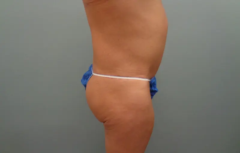 Butt augmentation Before & After Pictures in Nashville, TN