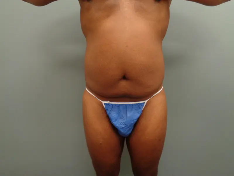 Body Lift Before & After Pictures in Nashville, TN