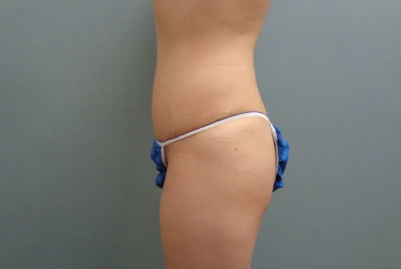 Tummy Tuck Before & After Pictures in Nashville, TN