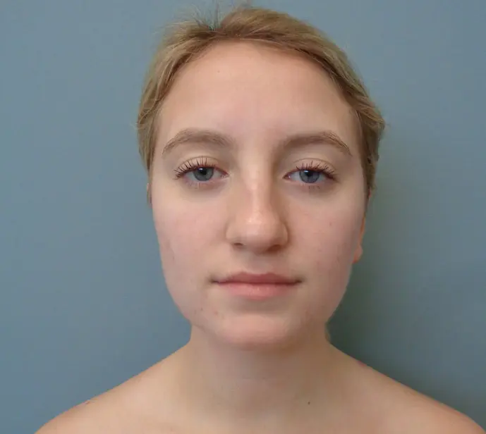 Rhinoplasty Before & After Pictures in Nashville, TN