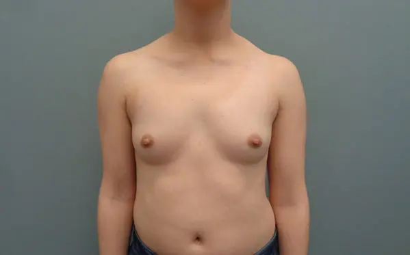 Breast Augmentation Before & After Pictures in Nashville, TN