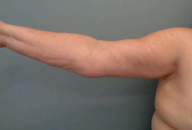 Arm Lift Before & After Pictures in Nashville, TN