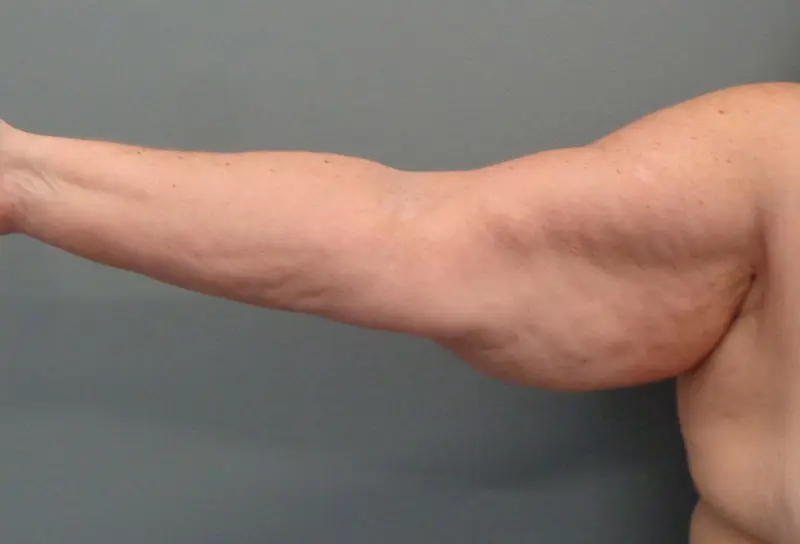 Arm Lift Before & After Pictures in Nashville, TN