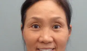 Blepharoplasty Before & After Pictures in Nashville, TN