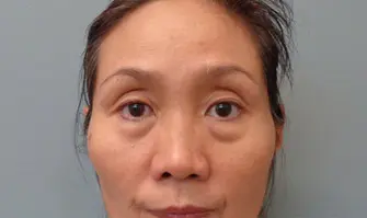 Blepharoplasty Before & After Pictures in Nashville, TN