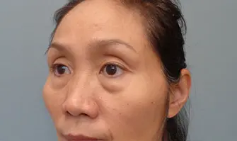 Blepharoplasty Before & After Pictures in Nashville, TN