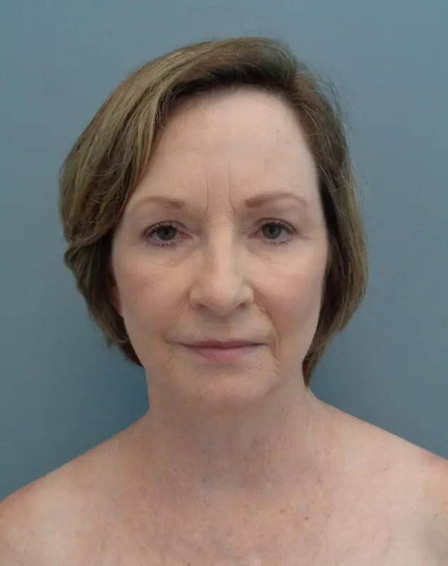 Facelift Before and After Pictures Nashville, TN