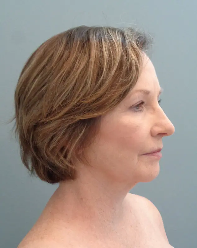 Facelift Before and After Pictures Nashville, TN