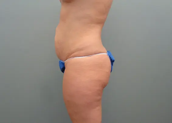 Abdominoplasty Before & After Pictures in Nashville, TN