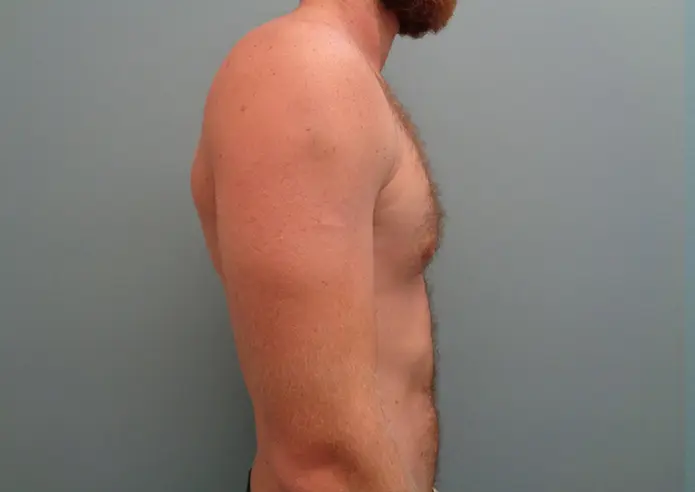 Gynecomastia Before & After Pictures in Nashville, TN