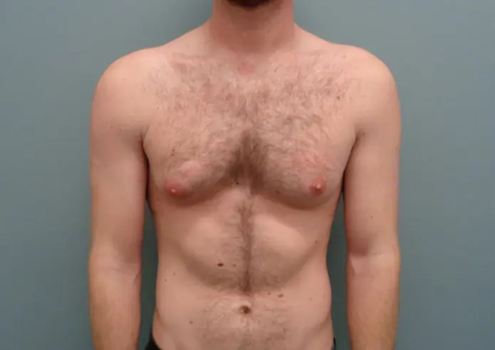 Gynecomastia Before & After Pictures in Nashville, TN