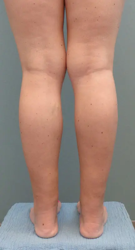 Liposuction Before and After Pictures Nashville, TN