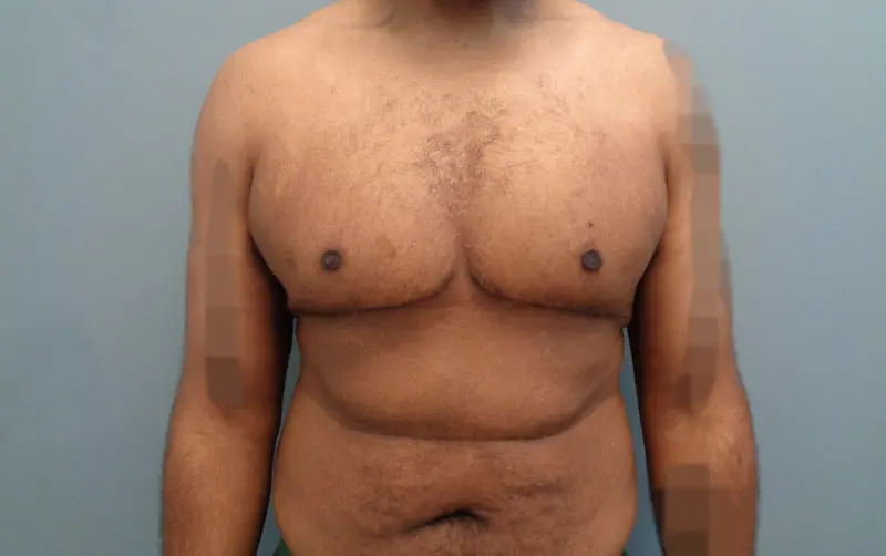 Gynecomastia Before and After Pictures Nashville, TN