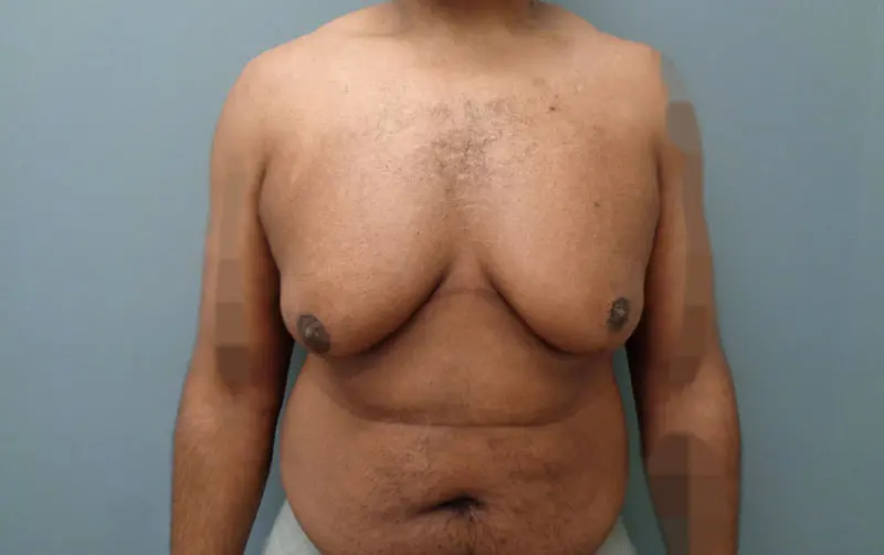 Gynecomastia Before and After Pictures Nashville, TN