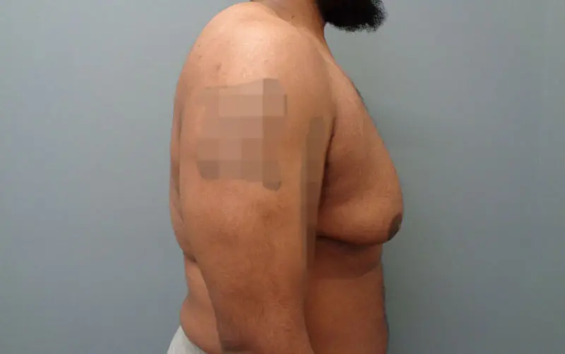 Gynecomastia Before and After Pictures Nashville, TN