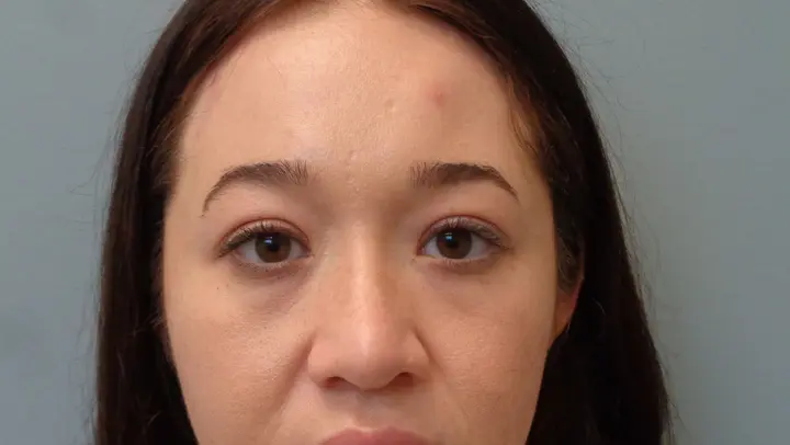 Browlift Before & After Pictures in Nashville, TN