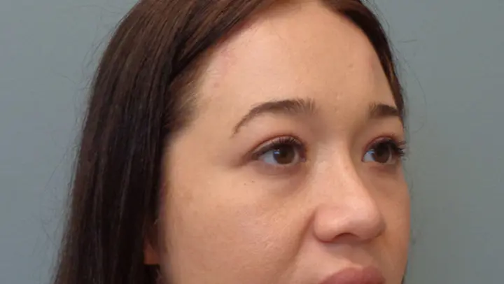 Browlift Before & After Pictures in Nashville, TN