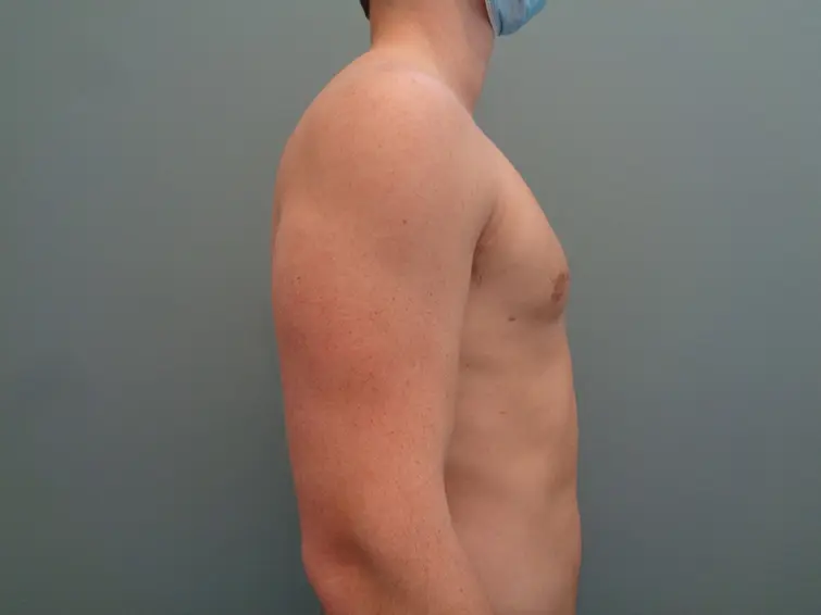 Gynecomastia Before & After Pictures in Nashville, TN