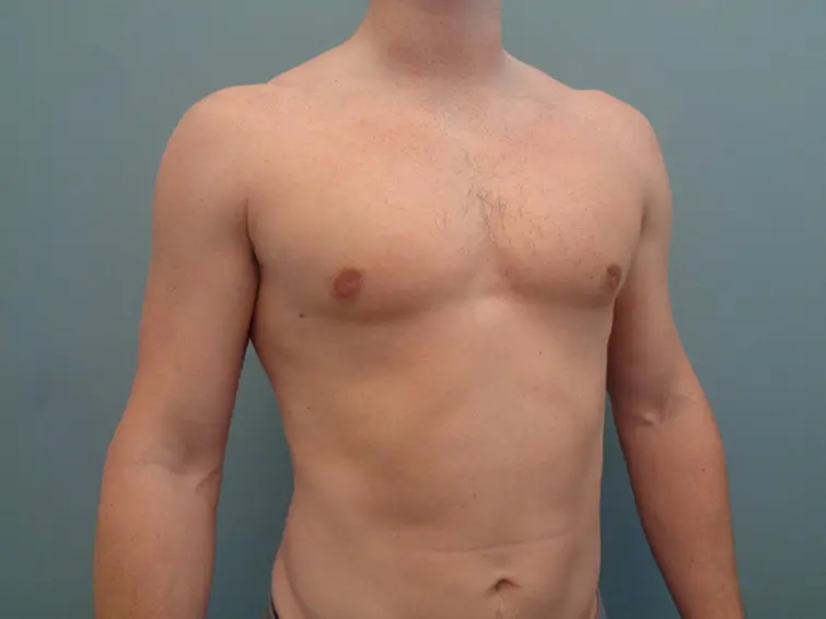 Gynecomastia Before & After Pictures in Nashville, TN