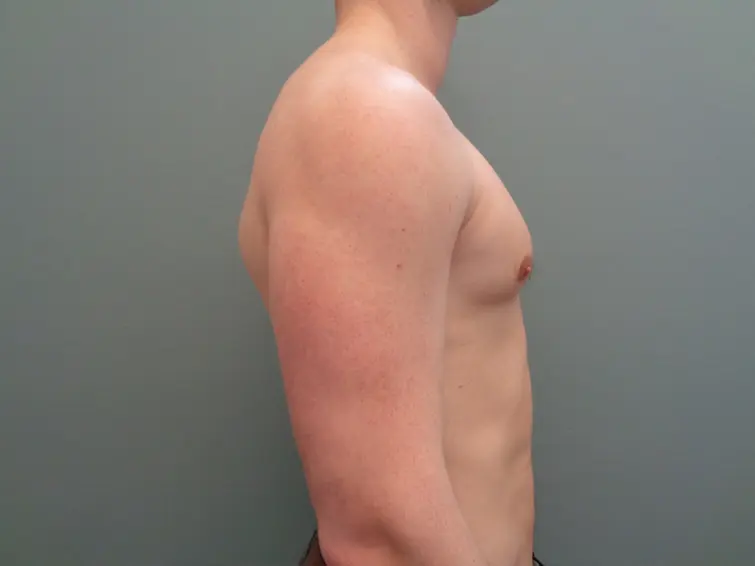 Gynecomastia Before & After Pictures in Nashville, TN