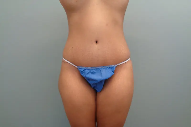 Tummy Tuck Before & After Pictures in Nashville, TN