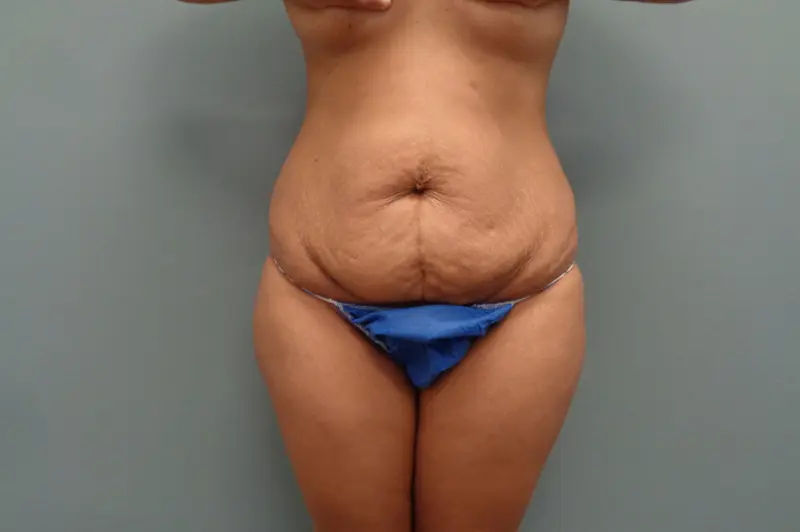 Tummy Tuck Before & After Pictures in Nashville, TN