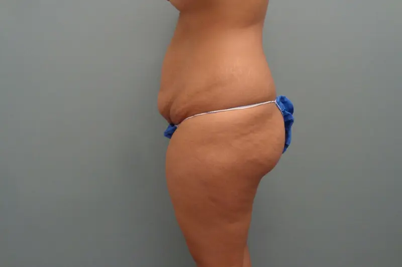 Tummy Tuck Before & After Pictures in Nashville, TN