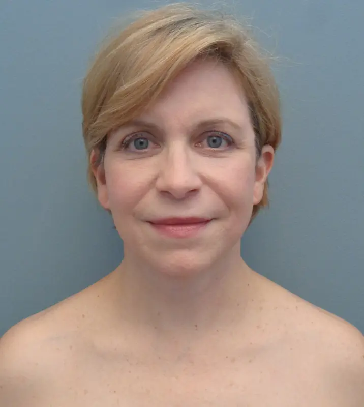 Facelift Before & After Pictures in Nashville, TN