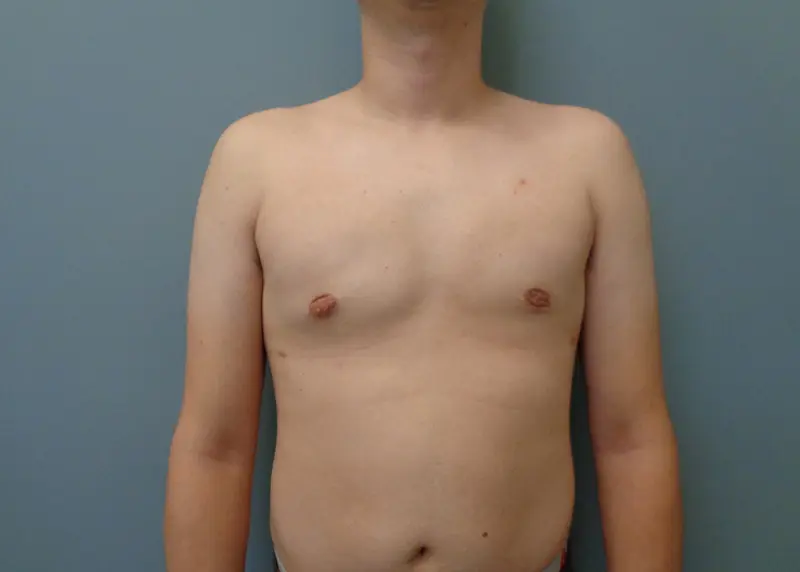 Gynecomastia Before and After Pictures Nashville, TN
