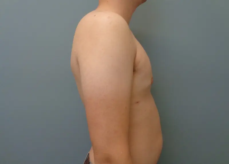 Gynecomastia Before and After Pictures Nashville, TN