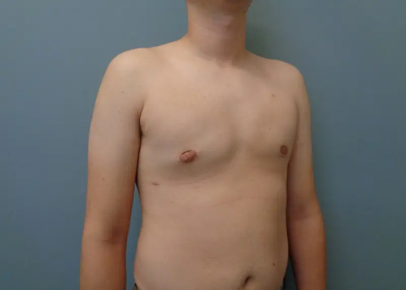 Gynecomastia Before and After Pictures Nashville, TN