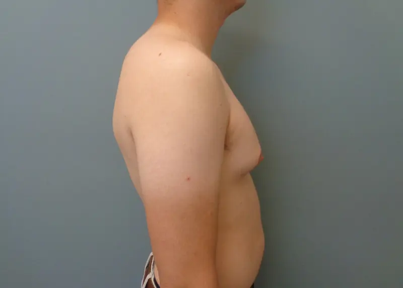 Gynecomastia Before and After Pictures Nashville, TN