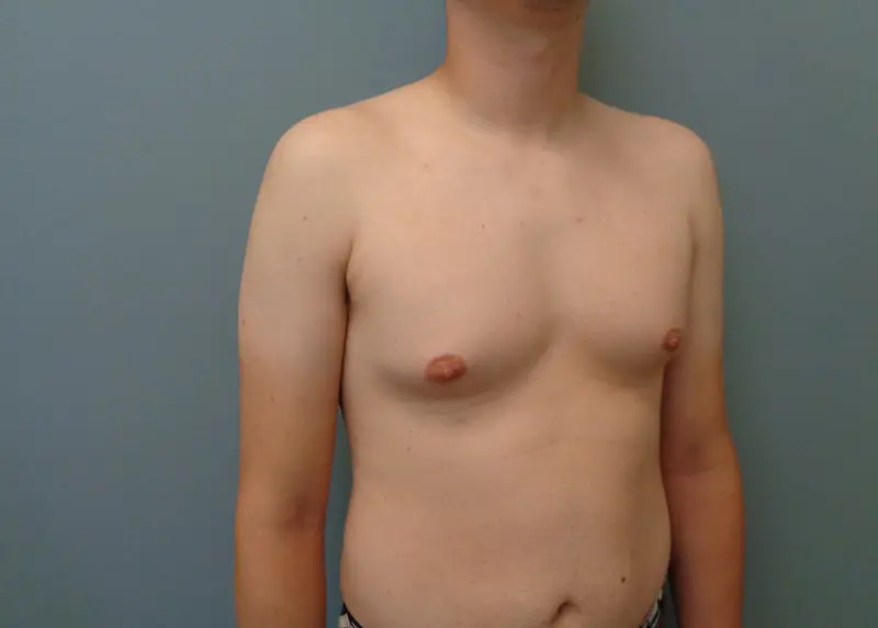 Gynecomastia Before and After Pictures Nashville, TN