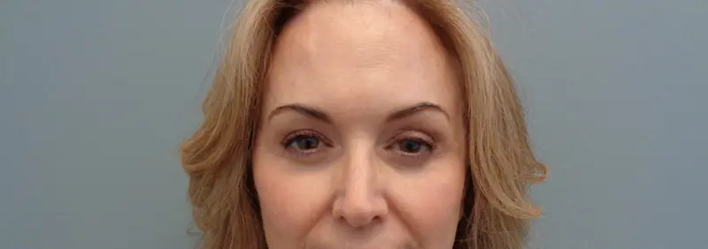 Brow Lift Before and After Pictures in Nashville, TN