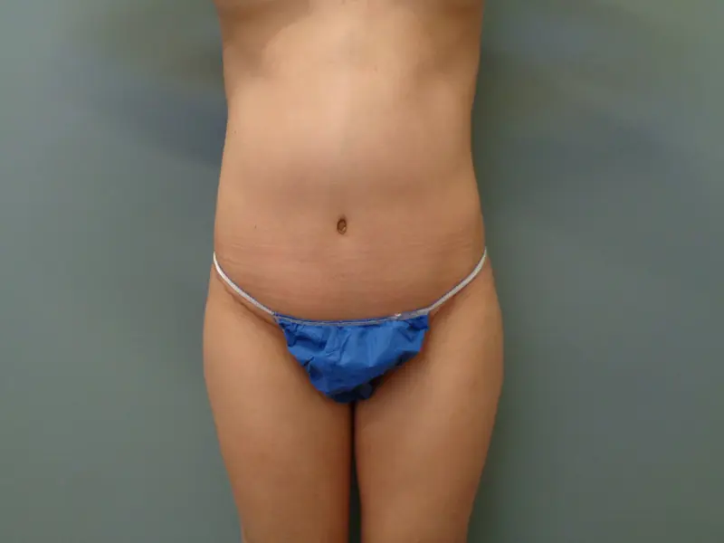 TUMMY TUCK BEFORE & AFTER PICTURES IN NASHVILLE, TN