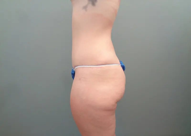 Mommy Makeover Before & After Pictures in Nashville, TN