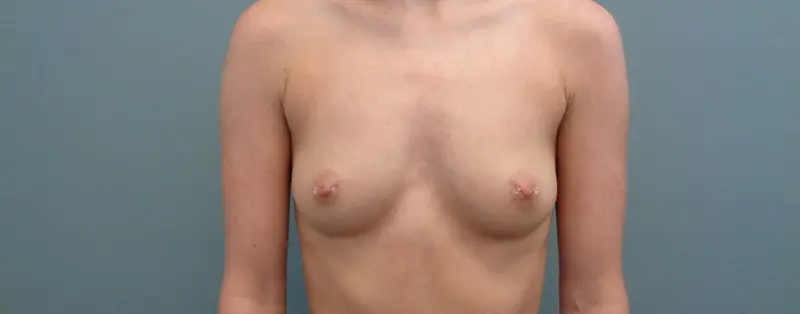 BREAST AUGMENTATION BEFORE & AFTER PICTURES IN NASHVILLE, TN