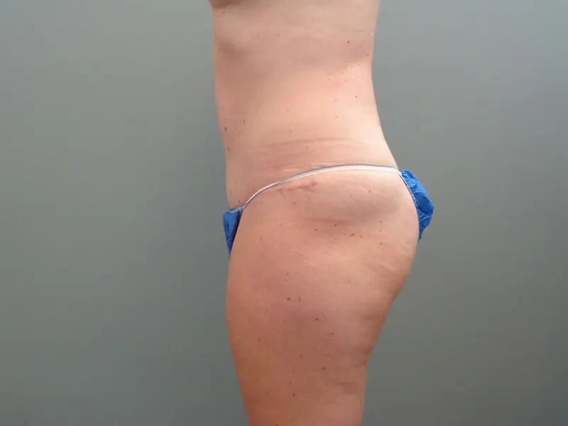 Tummy Tuck Before & After Pictures in Nashville, TN