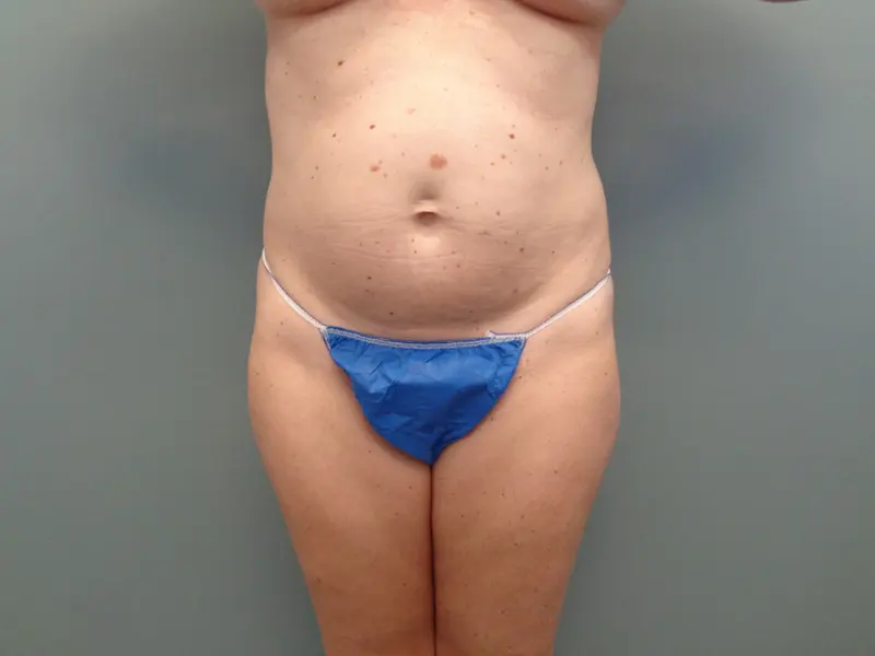 Tummy Tuck Before & After Pictures in Nashville, TN
