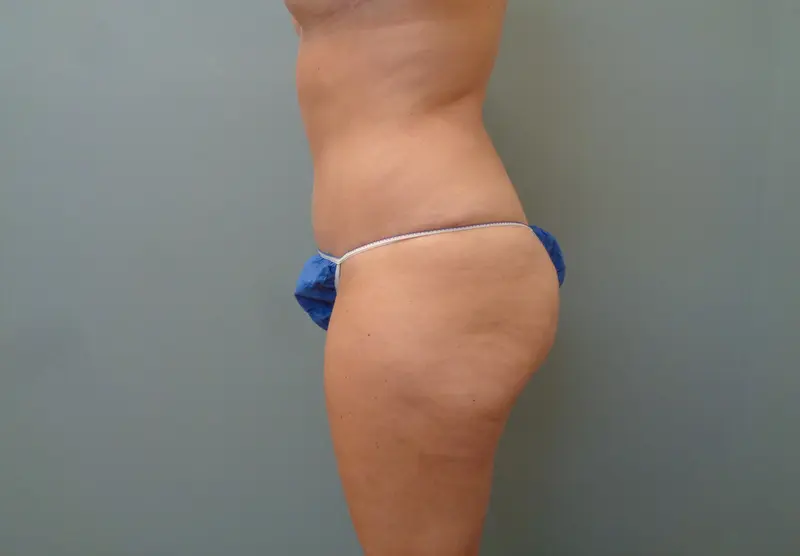 Mommy Makeover Before & After Pictures in Nashville, TN
