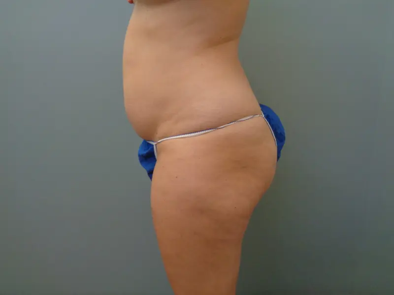 Mommy Makeover Before & After Pictures in Nashville, TN