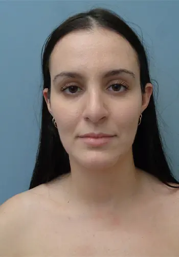 Rhinoplasty Before and After Pictures Nashville, TN