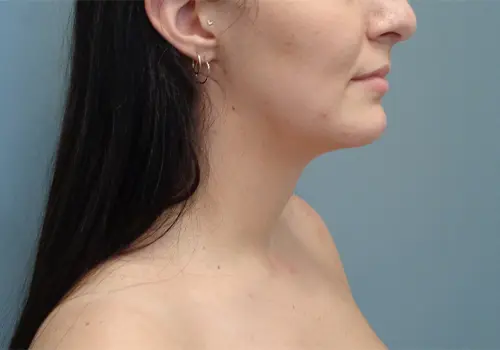 Chin Augmentation Before & After Pictures in Nashville, TN