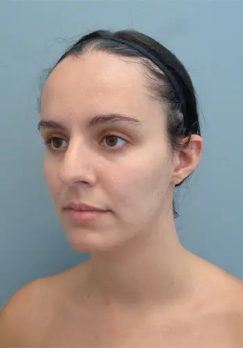 Rhinoplasty Before and After Pictures Nashville, TN