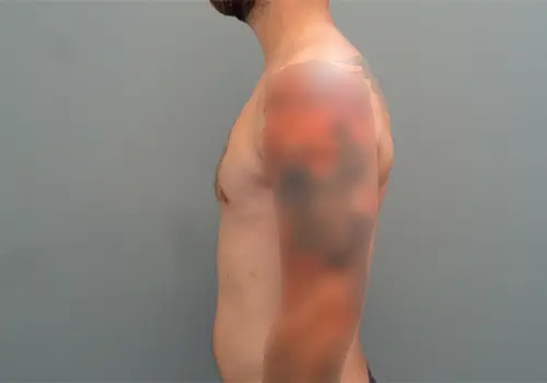 Gynecomastia Before & After Pictures in Nashville, TN