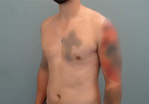 Gynecomastia Before & After Pictures in Nashville, TN